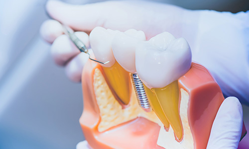 Cincinnati Dental Procedures